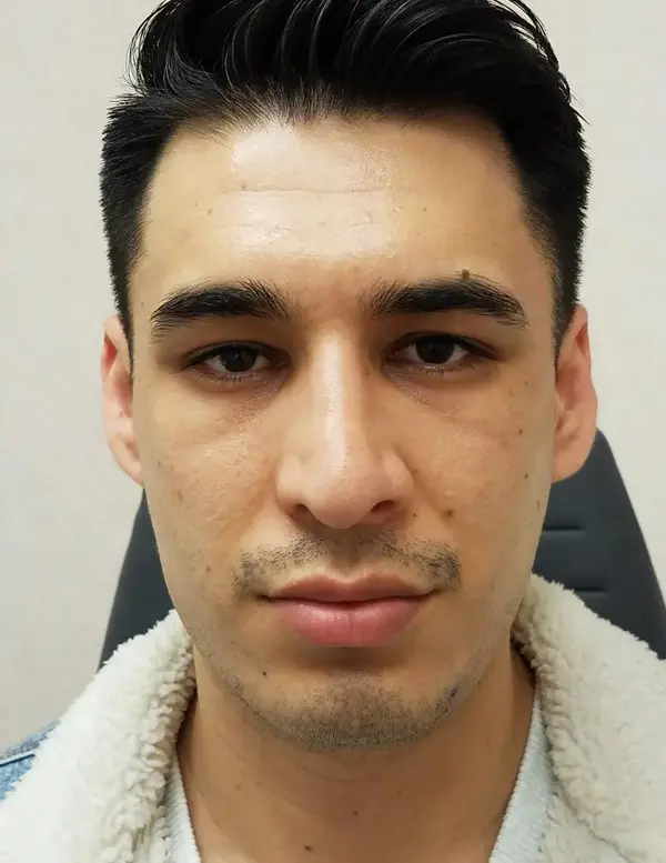 Rhinoplasty — after, front — Dr. Faramarz Shabdiz, MD. Individual results vary.
