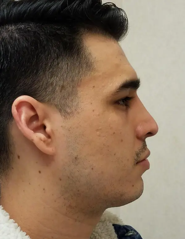 Rhinoplasty — after, right profile — Dr. Faramarz Shabdiz, MD. Individual results vary.