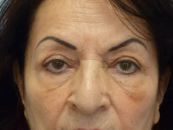 Additional Results — result photo, Dr. Faramarz Shabdiz, MD, Orange County, CA. Individual results vary.