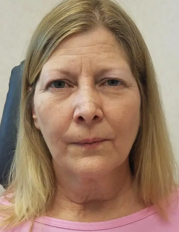Rhinoplasty — result photo, front view, Dr. Faramarz Shabdiz, MD, Orange County, CA. Individual results vary.
