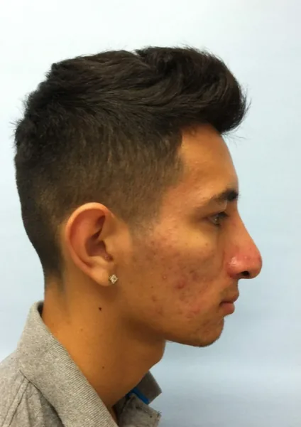 Additional Results — result photo, Dr. Faramarz Shabdiz, MD, Orange County, CA. Individual results vary.