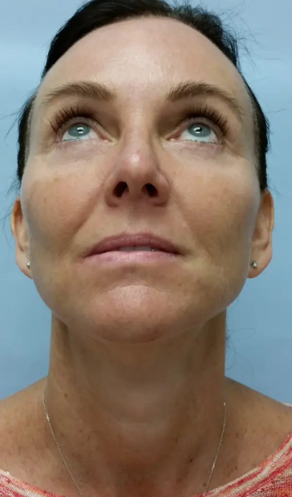 Rhinoplasty — after, base view — Dr. Faramarz Shabdiz, MD. Individual results vary.