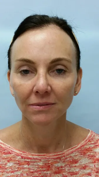 Additional Results — result photo, Dr. Faramarz Shabdiz, MD, Orange County, CA. Individual results vary.