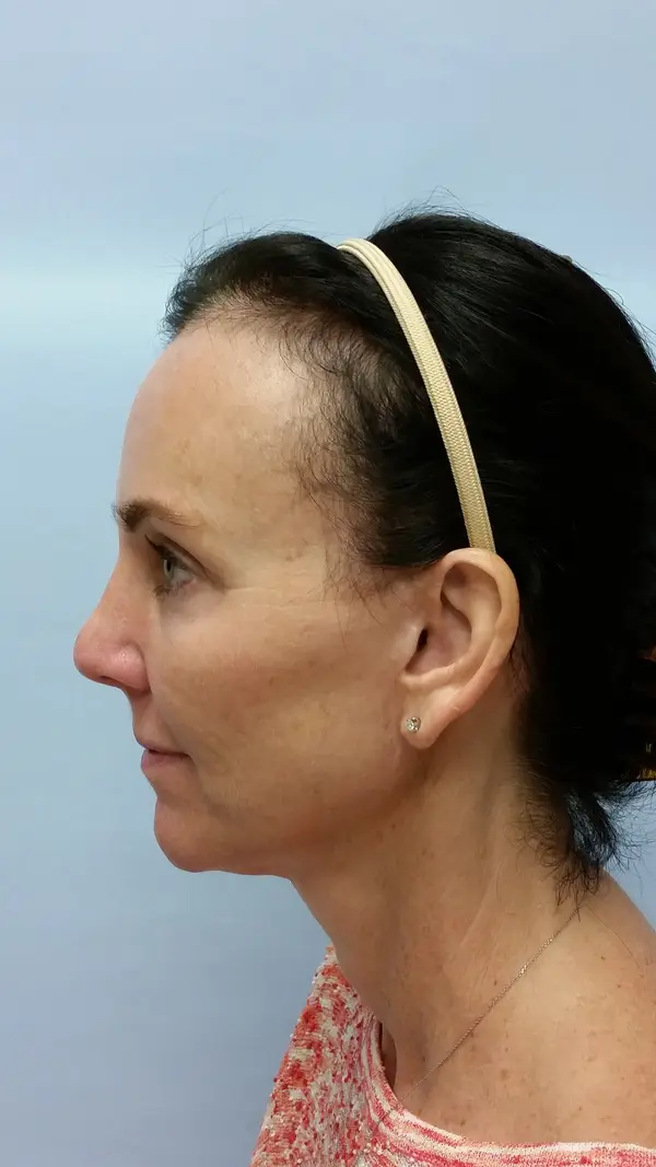 Rhinoplasty — after, left profile — Dr. Faramarz Shabdiz, MD. Individual results vary.