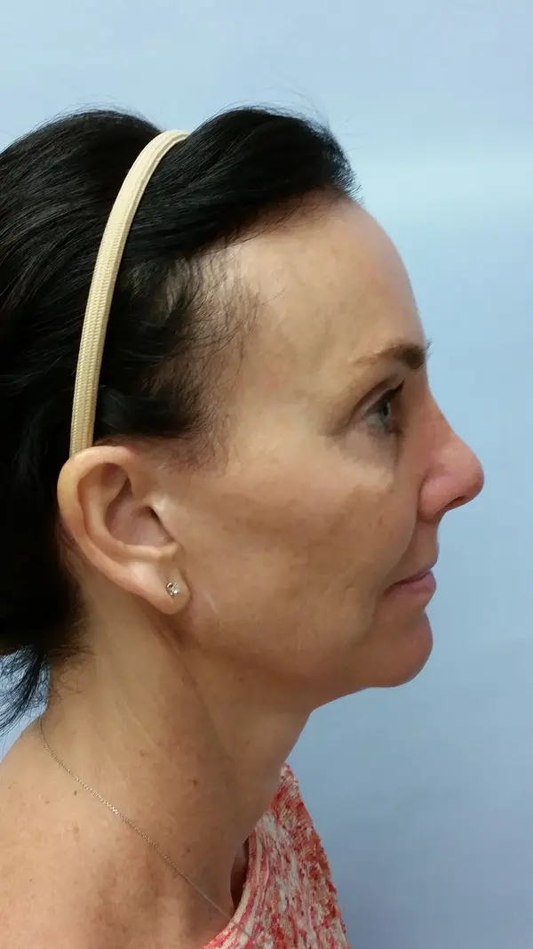Rhinoplasty — after, right profile — Dr. Faramarz Shabdiz, MD. Individual results vary.