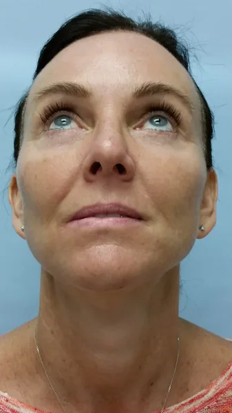 Additional Results — result photo, Dr. Faramarz Shabdiz, MD, Orange County, CA. Individual results vary.