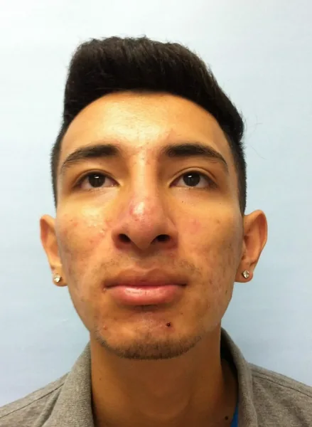 Additional Results — result photo, Dr. Faramarz Shabdiz, MD, Orange County, CA. Individual results vary.
