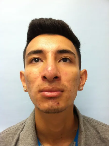 Additional Results — result photo, Dr. Faramarz Shabdiz, MD, Orange County, CA. Individual results vary.
