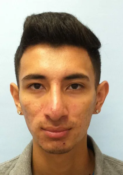 Additional Results — result photo, Dr. Faramarz Shabdiz, MD, Orange County, CA. Individual results vary.