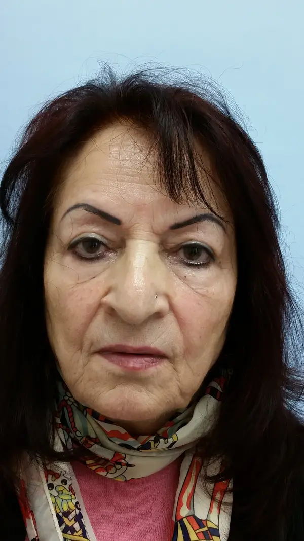 Rhinoplasty — after — Dr. Faramarz Shabdiz, MD. Individual results vary.