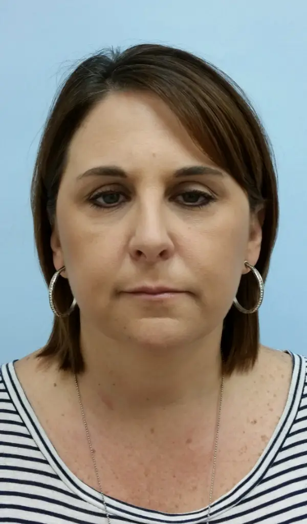 Rhinoplasty — after, front — Dr. Faramarz Shabdiz, MD. Individual results vary.