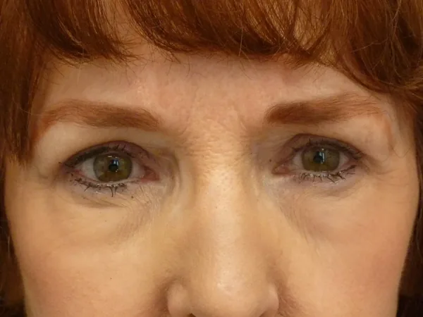 Additional Results — result photo, Dr. Faramarz Shabdiz, MD, Orange County, CA. Individual results vary.