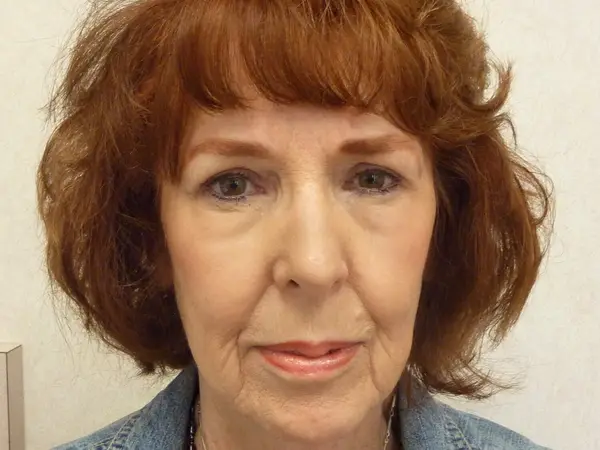 Rhinoplasty — after — Dr. Faramarz Shabdiz, MD. Individual results vary.
