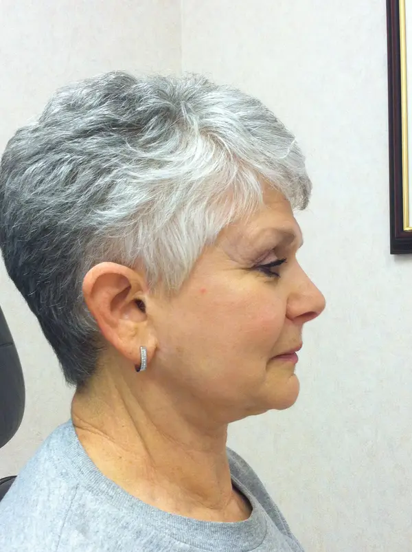 Rhinoplasty — after — Dr. Faramarz Shabdiz, MD. Individual results vary.