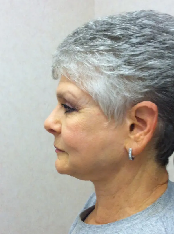 Rhinoplasty — after — Dr. Faramarz Shabdiz, MD. Individual results vary.