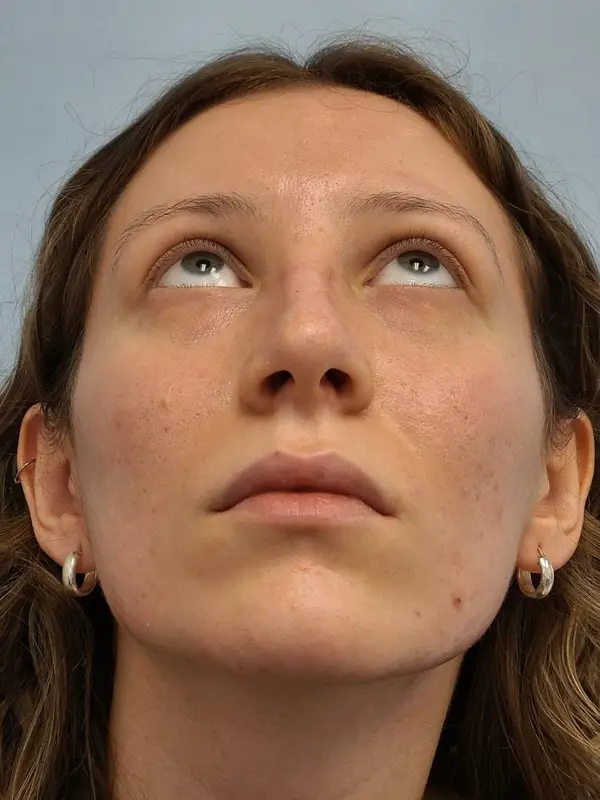 Rhinoplasty — after, base view — Dr. Faramarz Shabdiz, MD. Individual results vary.