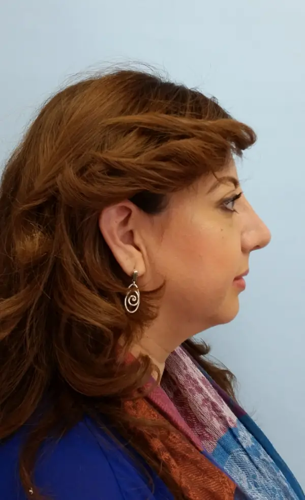 Rhinoplasty — after photo, right profile, Dr. Faramarz Shabdiz, MD, Orange County, CA. Individual results vary.