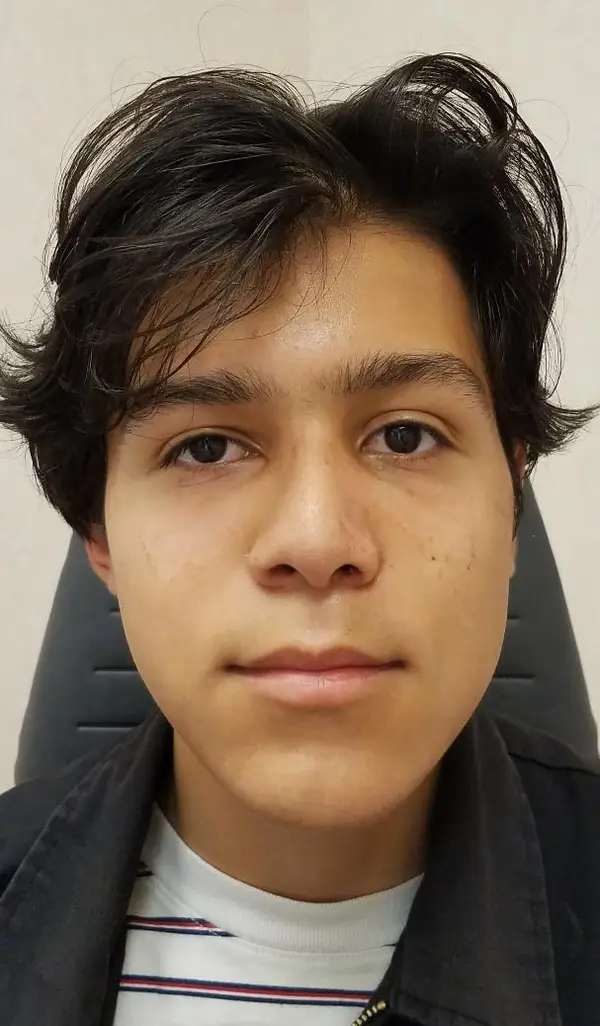 Rhinoplasty — after photo, front view, Dr. Faramarz Shabdiz, MD, Orange County, CA. Individual results vary.