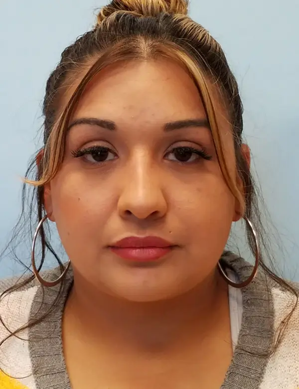 Rhinoplasty — after, front — Dr. Faramarz Shabdiz, MD. Individual results vary.