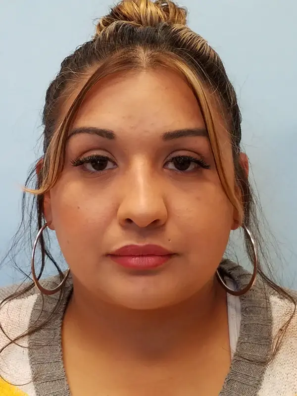 Rhinoplasty — after photo, front view, Dr. Faramarz Shabdiz, MD, Orange County, CA. Individual results vary.