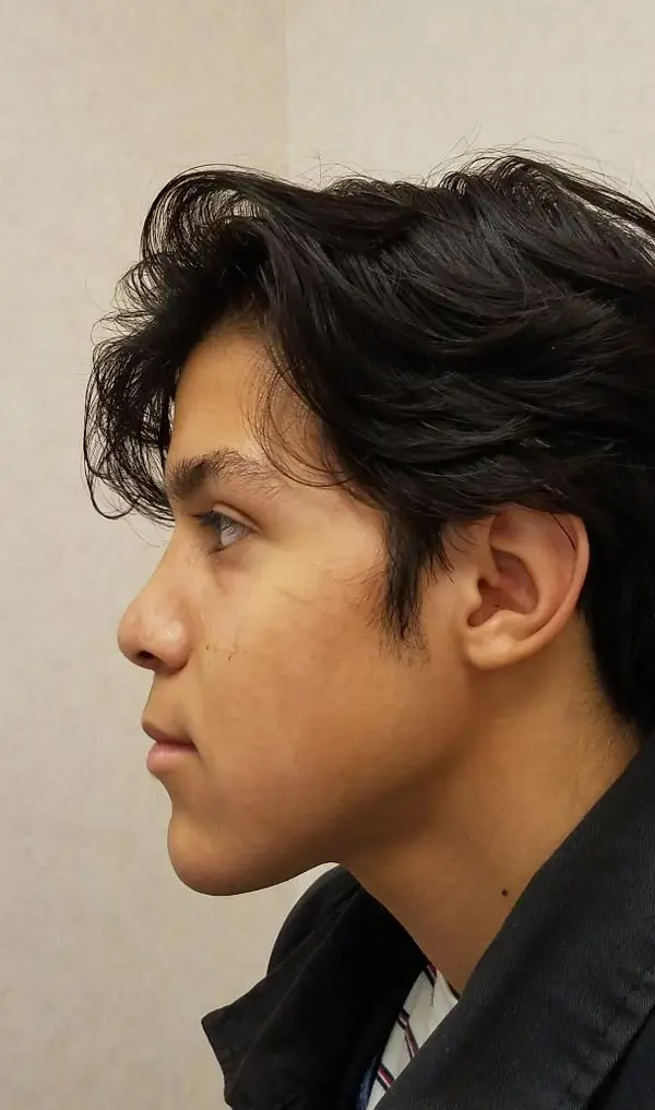 Rhinoplasty — after, left profile — Dr. Faramarz Shabdiz, MD. Individual results vary.