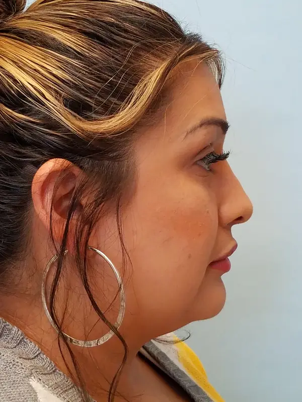 Rhinoplasty — after, right profile — Dr. Faramarz Shabdiz, MD. Individual results vary.