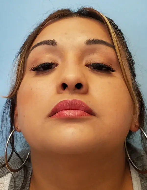 Rhinoplasty — after, base view — Dr. Faramarz Shabdiz, MD. Individual results vary.