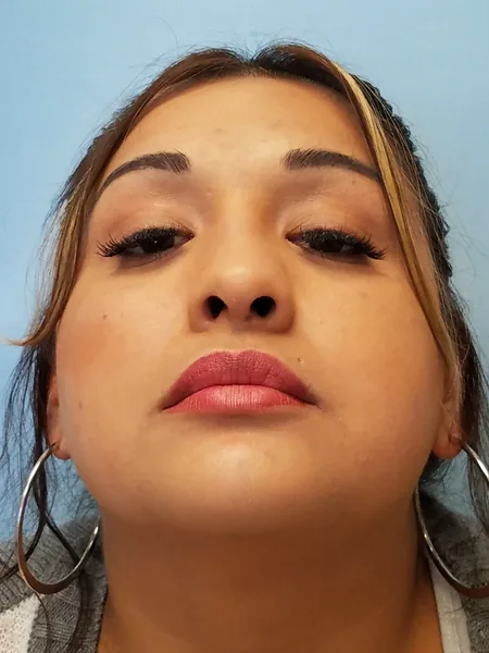 Additional Results — after photo, base view, Dr. Faramarz Shabdiz, MD, Orange County, CA. Individual results vary.