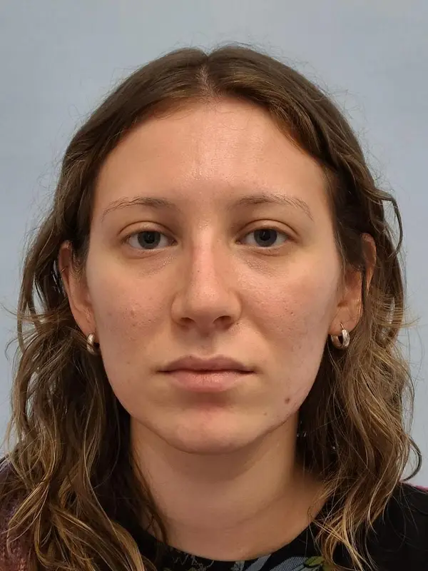Rhinoplasty — after, front — Dr. Faramarz Shabdiz, MD. Individual results vary.