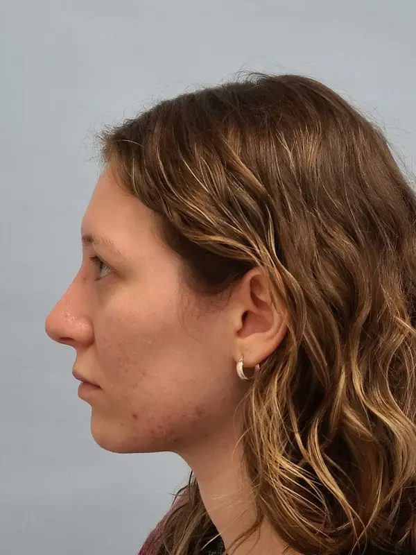 Rhinoplasty — after, left profile — Dr. Faramarz Shabdiz, MD. Individual results vary.