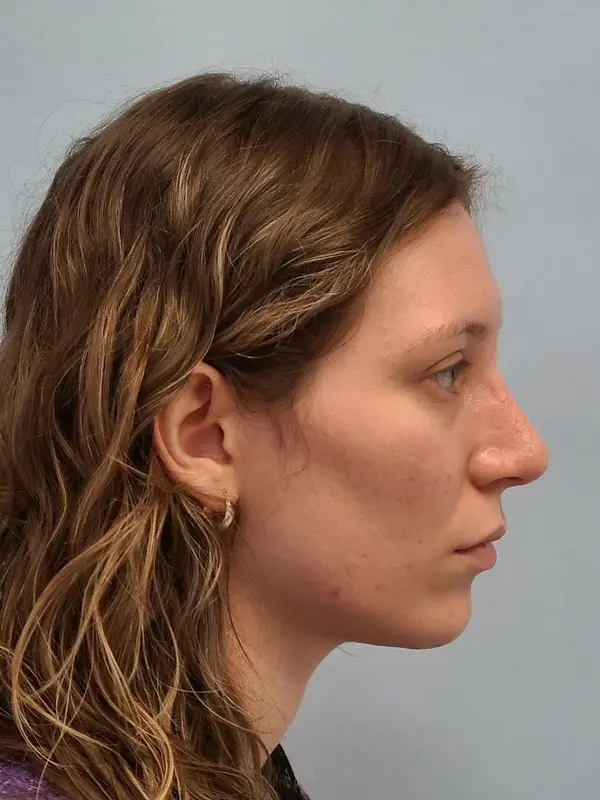 Rhinoplasty — after, right profile — Dr. Faramarz Shabdiz, MD. Individual results vary.