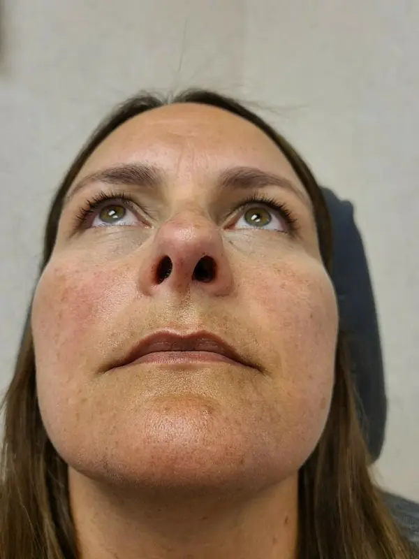 Facial Tumor & Reconstruction — after photo, Dr. Faramarz Shabdiz, MD, Orange County, CA. Individual results vary.
