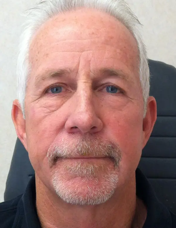 Rhinoplasty — after, front — Dr. Faramarz Shabdiz, MD. Individual results vary.