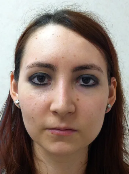 Rhinoplasty — after photo, front view, Dr. Faramarz Shabdiz, MD, Orange County, CA. Individual results vary.
