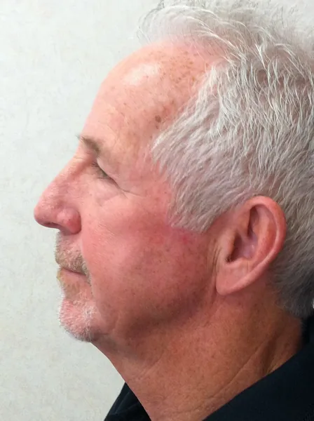 Additional Results — after photo, left profile, Dr. Faramarz Shabdiz, MD, Orange County, CA. Individual results vary.