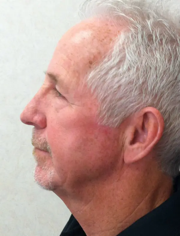 Rhinoplasty — after, left profile — Dr. Faramarz Shabdiz, MD. Individual results vary.