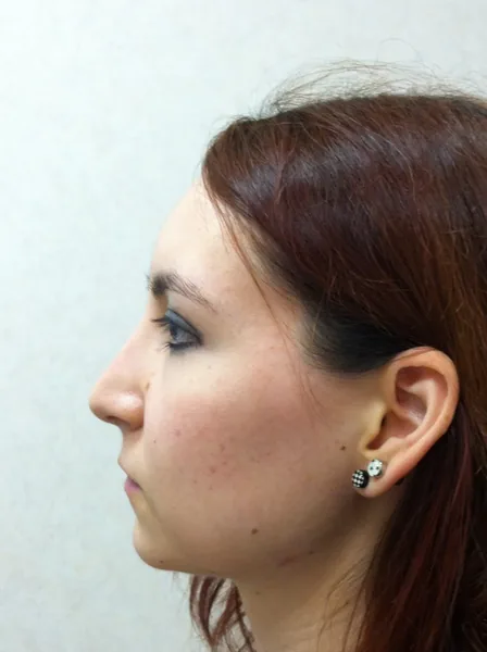 Rhinoplasty — after photo, left profile, Dr. Faramarz Shabdiz, MD, Orange County, CA. Individual results vary.