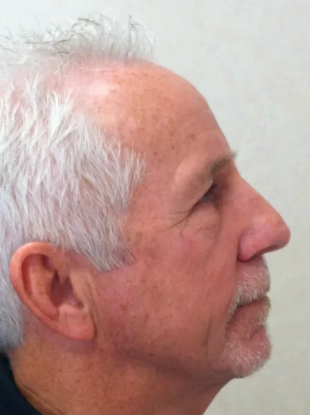 Additional Results — after photo, right profile, Dr. Faramarz Shabdiz, MD, Orange County, CA. Individual results vary.