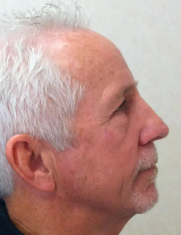 Rhinoplasty — after, right profile — Dr. Faramarz Shabdiz, MD. Individual results vary.