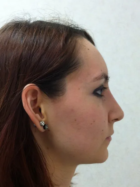 Rhinoplasty — after photo, right profile, Dr. Faramarz Shabdiz, MD, Orange County, CA. Individual results vary.
