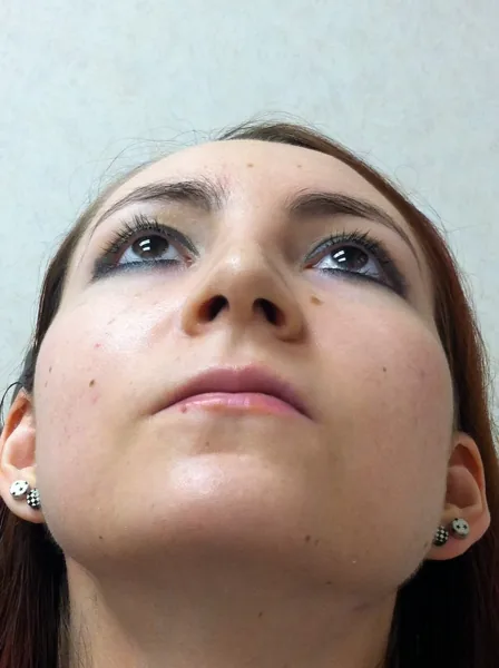 Rhinoplasty — after photo, base view, Dr. Faramarz Shabdiz, MD, Orange County, CA. Individual results vary.