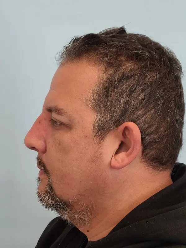 Rhinoplasty — after, left profile — Dr. Faramarz Shabdiz, MD. Individual results vary.