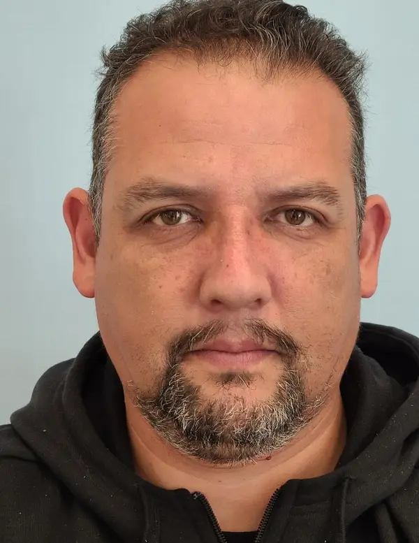 Rhinoplasty — after, front — Dr. Faramarz Shabdiz, MD. Individual results vary.