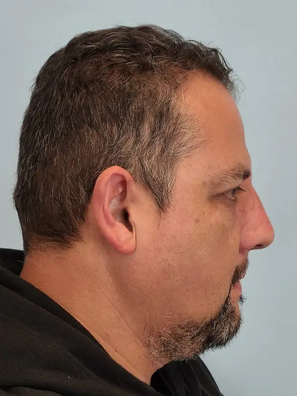 Rhinoplasty — after, right profile — Dr. Faramarz Shabdiz, MD. Individual results vary.