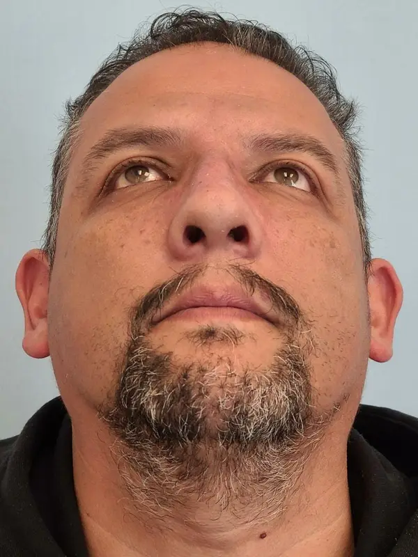 Rhinoplasty — after, base view — Dr. Faramarz Shabdiz, MD. Individual results vary.