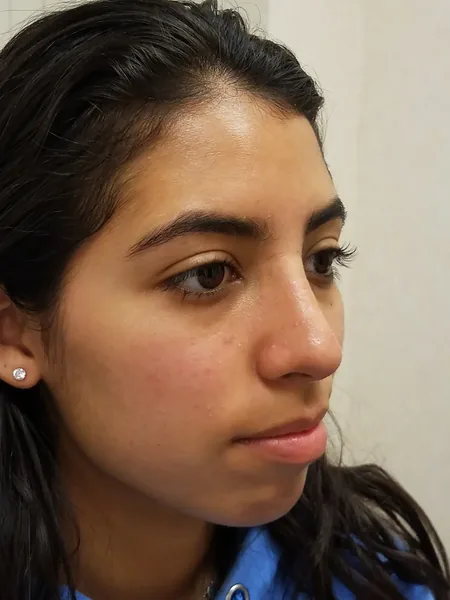 Additional Results — after photo, oblique view, Dr. Faramarz Shabdiz, MD, Orange County, CA. Individual results vary.