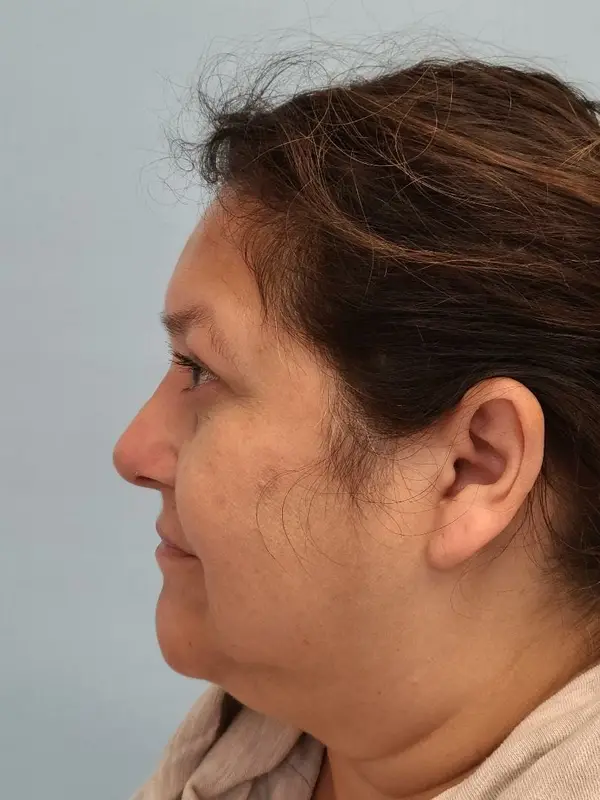 Rhinoplasty — after photo, left profile, Dr. Faramarz Shabdiz, MD, Orange County, CA. Individual results vary.