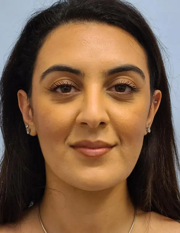 Rhinoplasty — after, front — Dr. Faramarz Shabdiz, MD. Individual results vary.