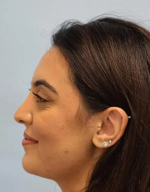 Rhinoplasty — after, left profile — Dr. Faramarz Shabdiz, MD. Individual results vary.