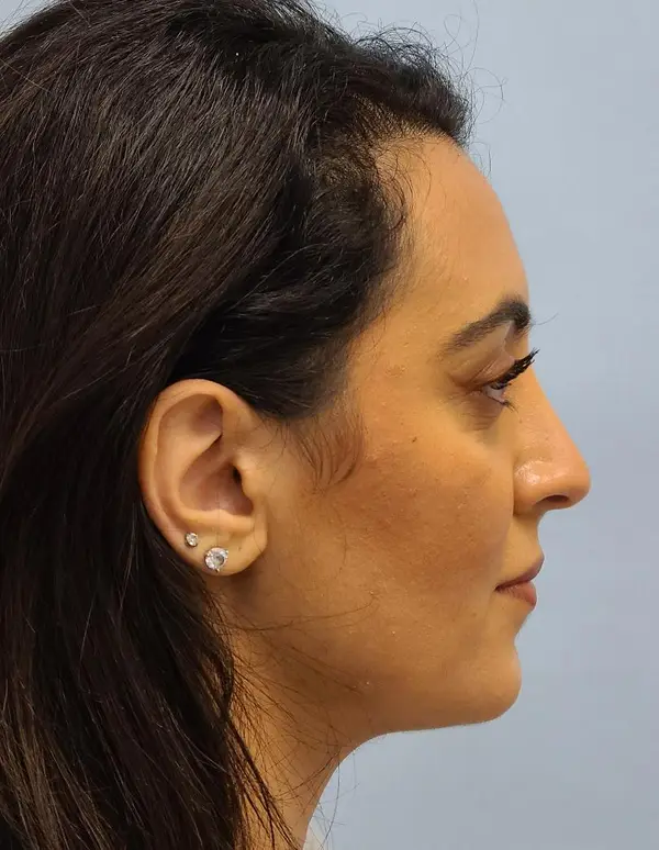 Rhinoplasty — after photo, right profile, Dr. Faramarz Shabdiz, MD, Orange County, CA. Individual results vary.